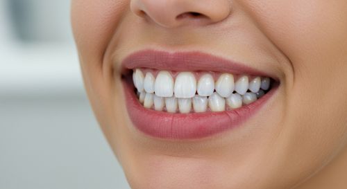 What are porcelain veneers?